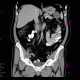 Macrocystic adenoma of pancreas: CT - Computed tomography